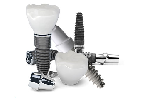 Dental Implants Jenson Dental Brigham City Utah
