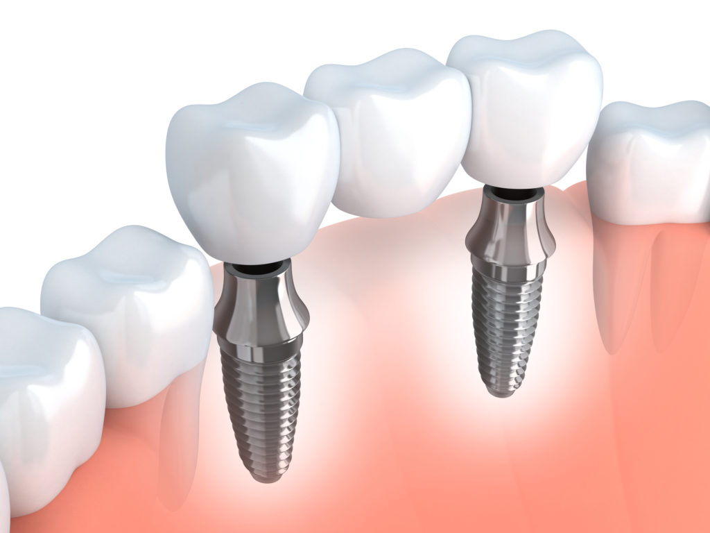 The Difference Between Dentures and dental implants tah Dental Implants