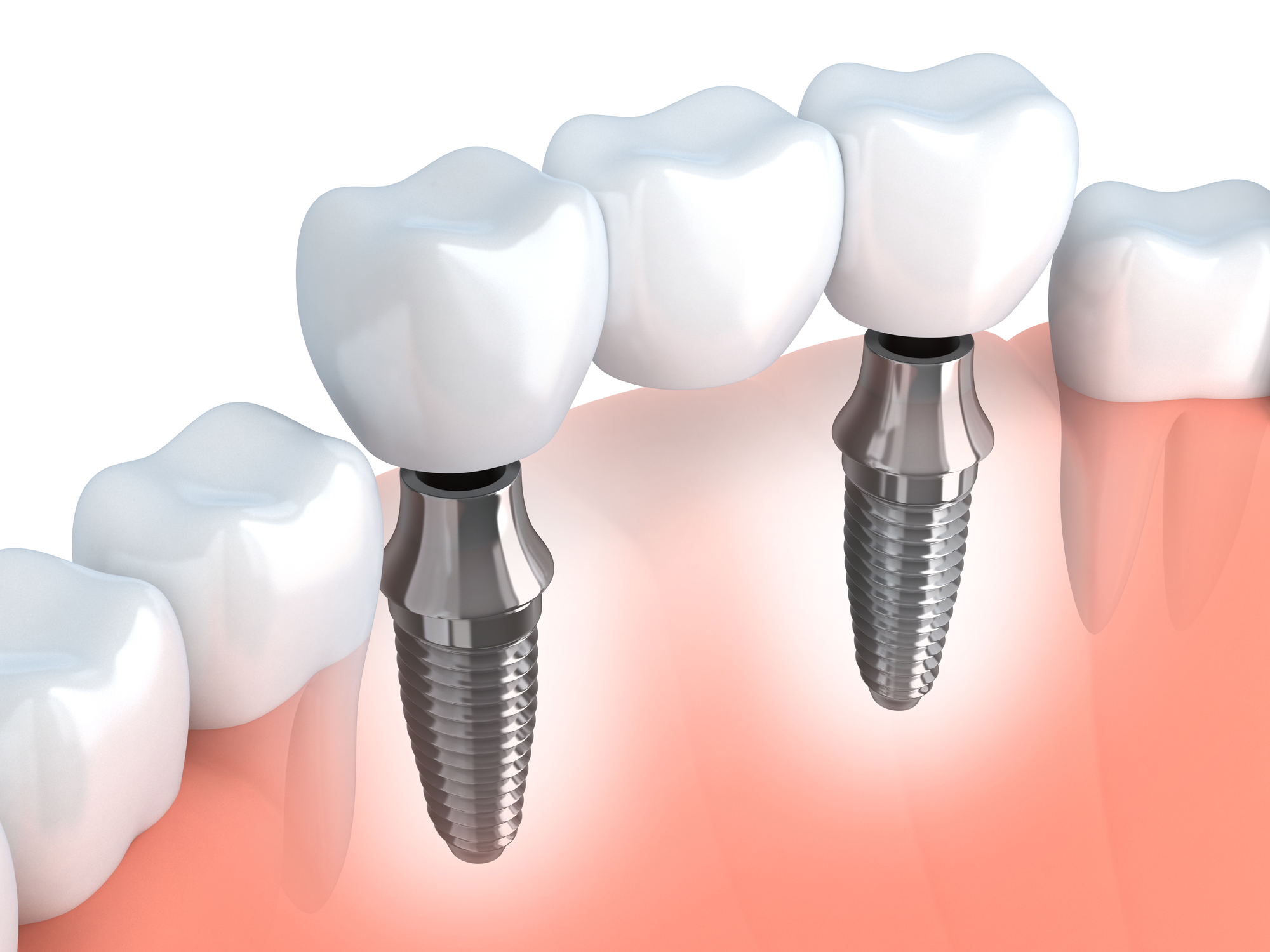 The Difference Between Dentures and dental implants tah Dental Implants