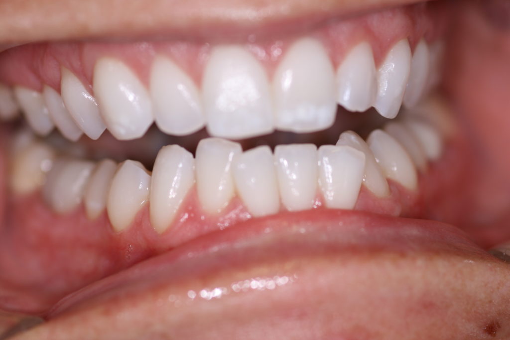 6 Month Smile Before Jenson Dental Brigham City Utah