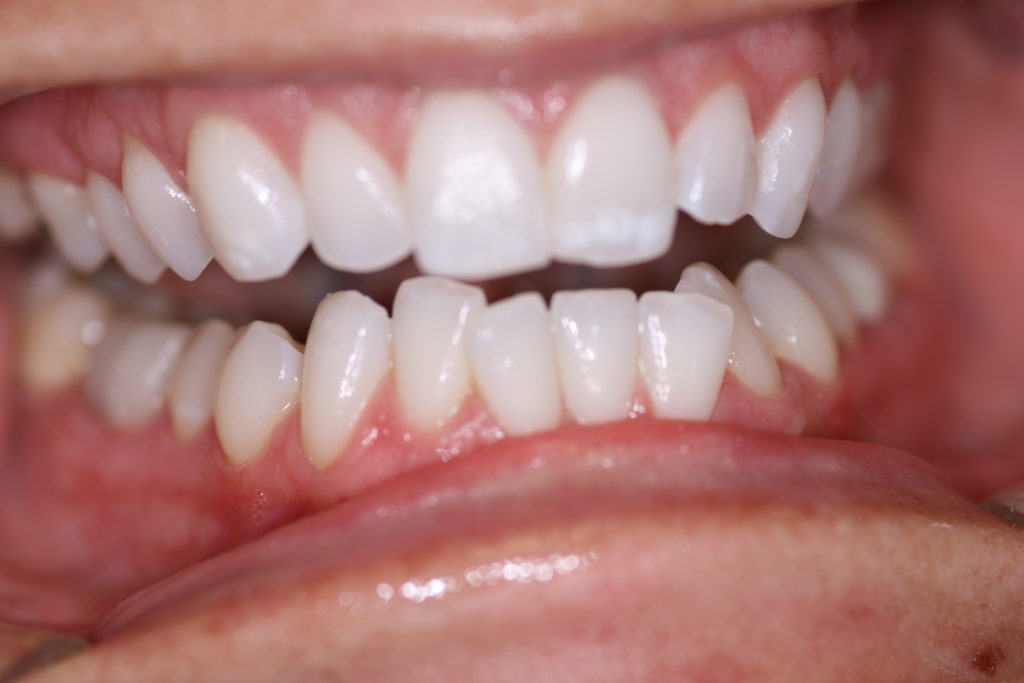 Smile Gallery 6 Month Smile Before Jenson Dental Brigham City Utah