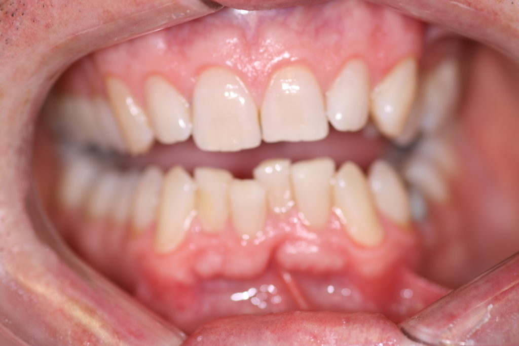 Smile Gallery 6 Month Smile Before Jenson Dental Brigham City Utah