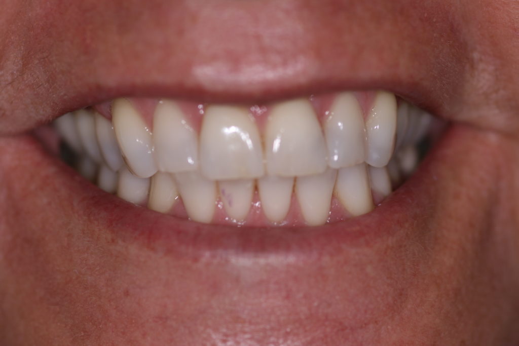 Jenson Dental Brigham City Utah 6 Month Smile After