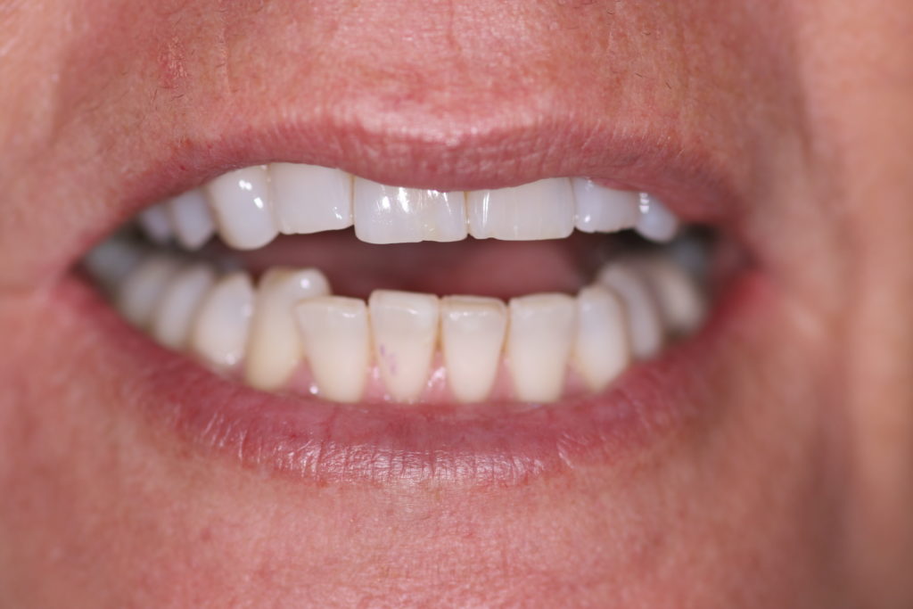 Smile Gallery 6 Month Smile Before Jenson Dental Brigham City Utah