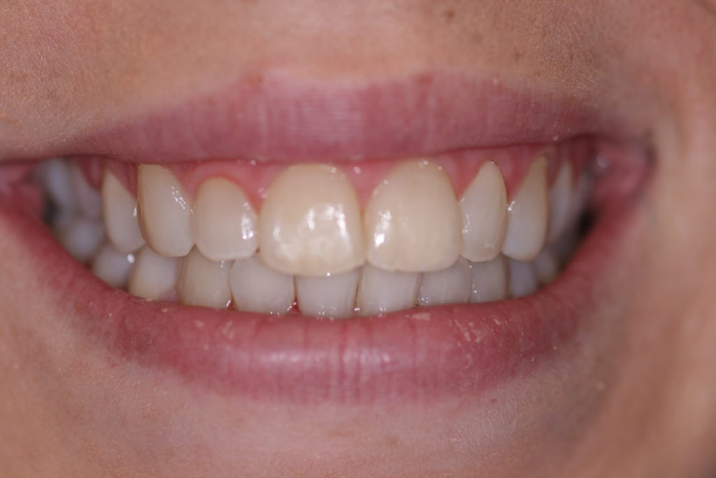 Jenson Dental Brigham City Utah 6 Month Smile After