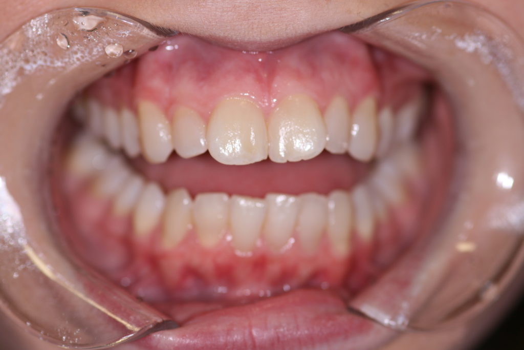 Smile Gallery 6 Month Smile Before Jenson Dental Brigham City Utah