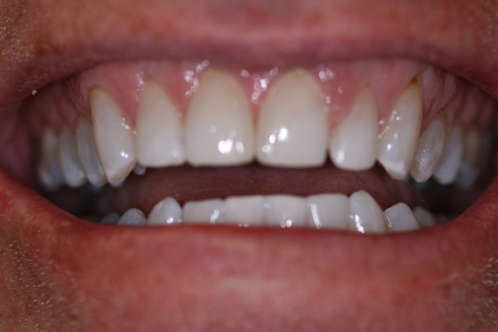 Smile Gallery Jenson Dental Brigham City Utah 6 Month Smile After