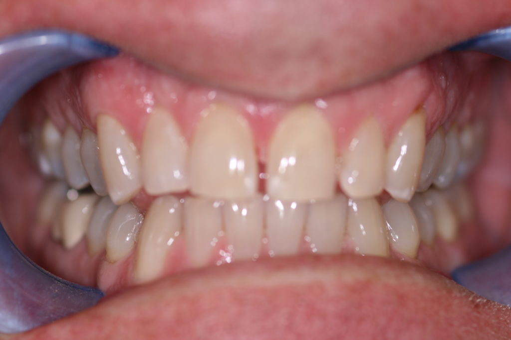 Smile Gallery 6 Month Smile Before Jenson Dental Brigham City Utah