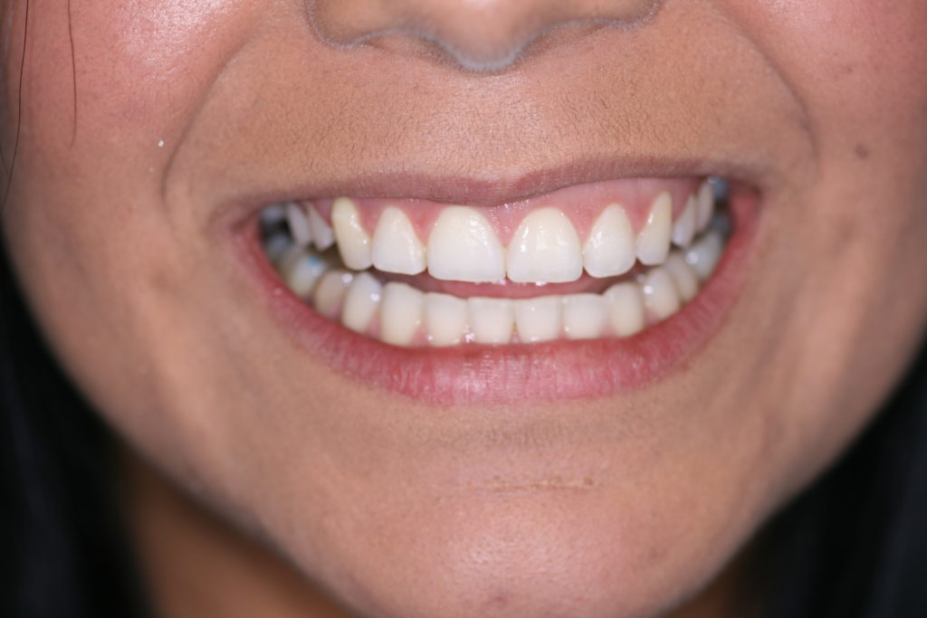 Jenson Dental Brigham City Utah 6 month smile 6 after