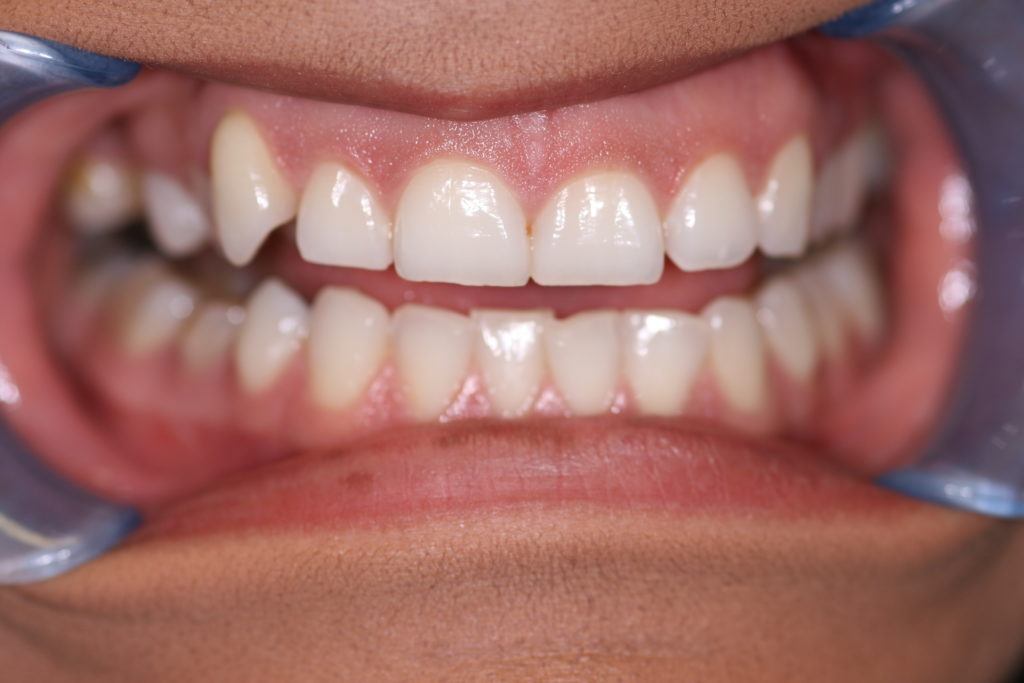 Smile Gallery 6 Month Smile 6 Before Jenson Dental Brigham City Utah