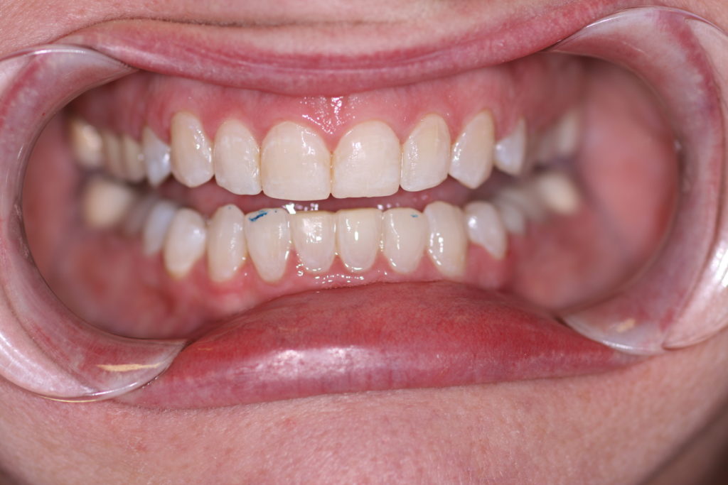 Smile Gallery Jenson Dental Brigham City Utah 6 Month Smile 7 After