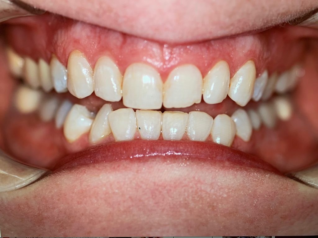 6 Month Smile 7 Before Jenson Dental Brigham City Utah