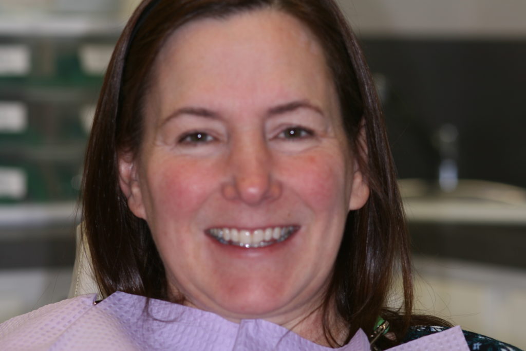 Smile Gallery 6 Month Smile 7 before Jenson Dental Brigham City Utah