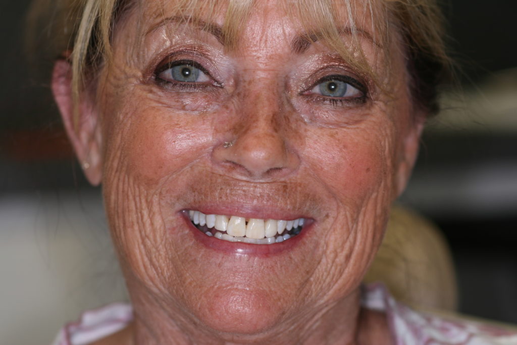 Smile Gallery Jenson Dental Brigham City Utah 6 Month Smile After