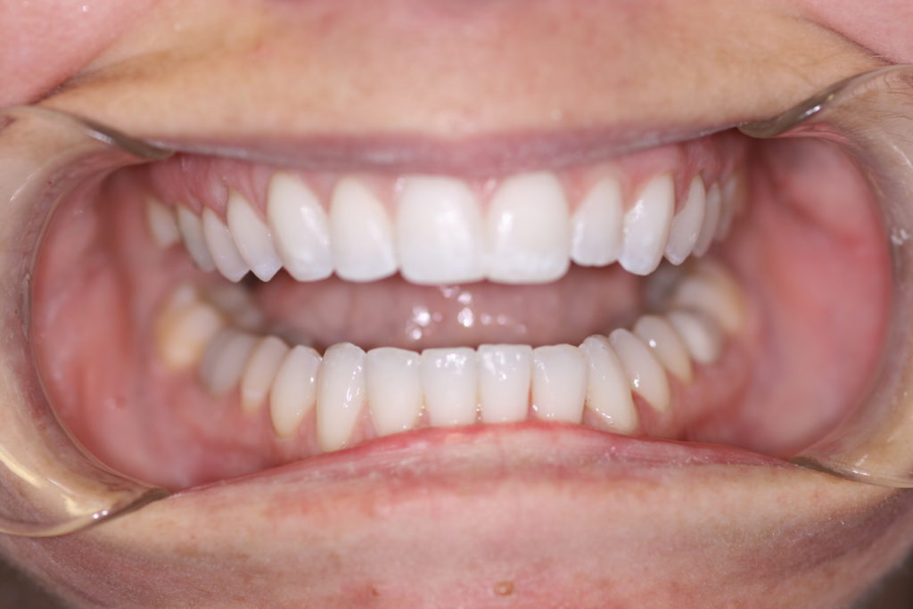 Jenson Dental Brigham City Utah 6 Month Smile After Smile Gallery