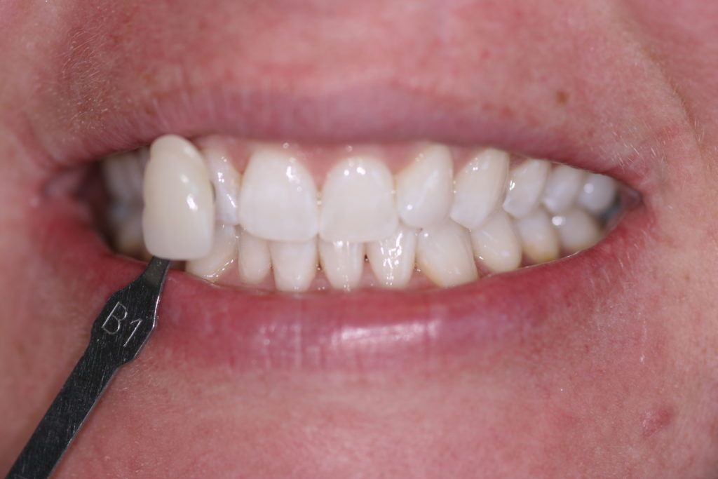 Smile Gallery Jenson Dental Brigham City Utah Whitening After