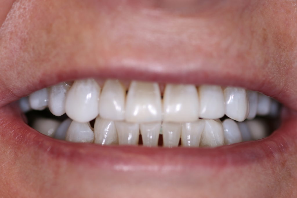 Smile Gallery Jenson Dental Brigham City Utah Whitening After