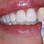 Jenson Dental Brigham City Utah Whitening After