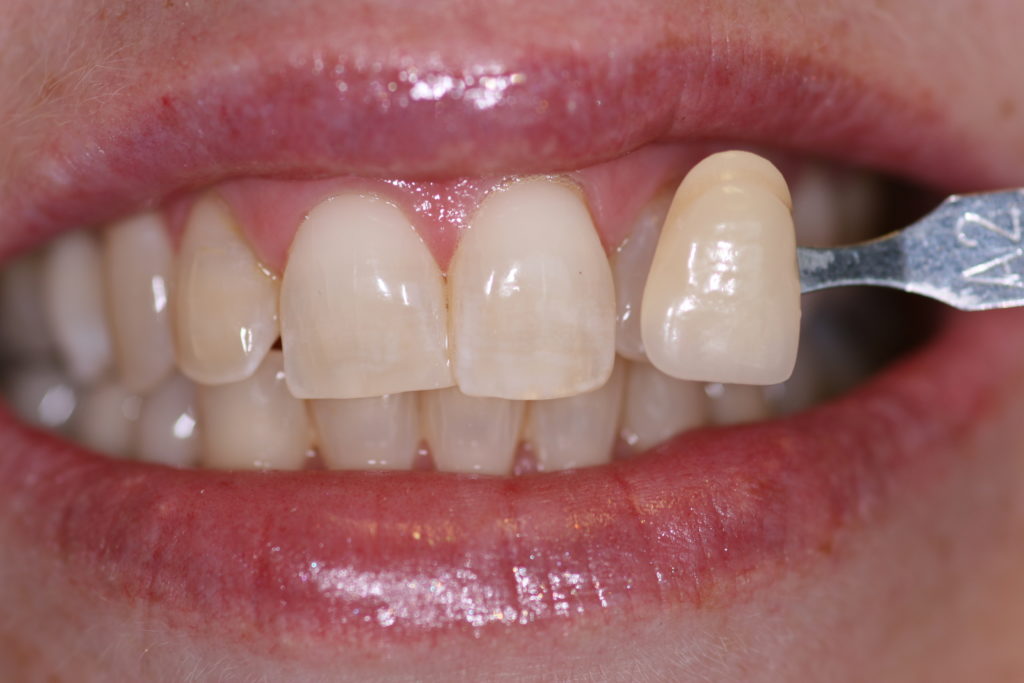 Smile Gallery Jenson Dental Brigham City Utah Whitening Before