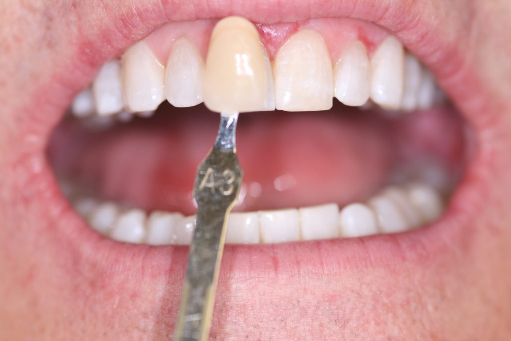 Smile Gallery Whitening After Jenson Dental Brigham City Utah