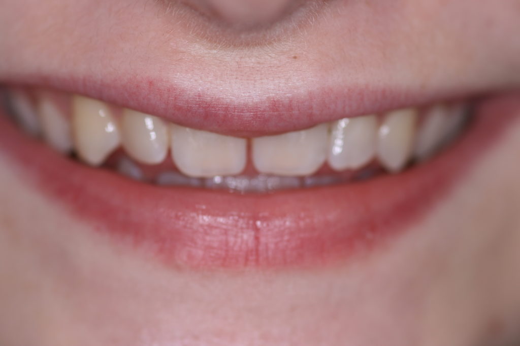 Smile Gallery Whitening Before Jenson Dental Brigham City Utah