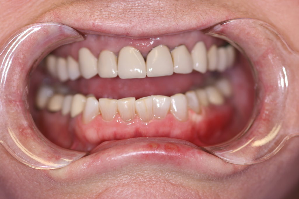 Smile Gallery Whitening Before Jenson Dental Brigham City Utah