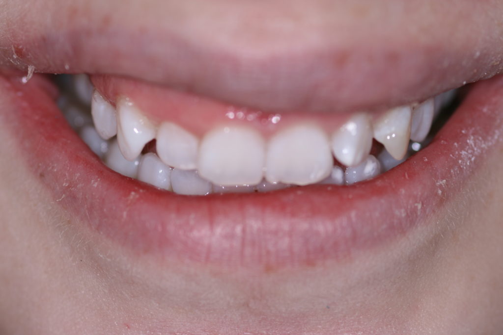 Smile Gallery Whitening After Jenson Dental Brigham City Utah