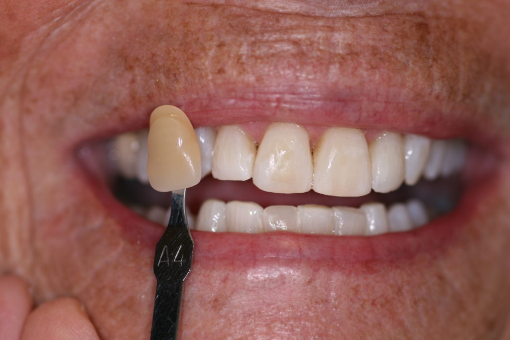 Jenson Dental Brigham City Utah Whitening After Cosmetic Dentistry