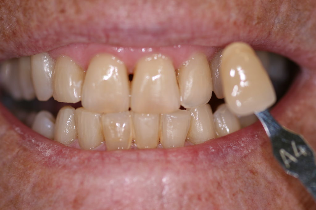 Smile Gallery Whitening Before Jenson Dental Brigham City Utah