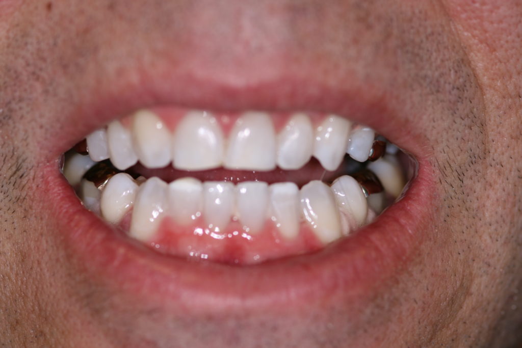 Smile Gallery Jenson Dental Brigham City Utah Whitening After