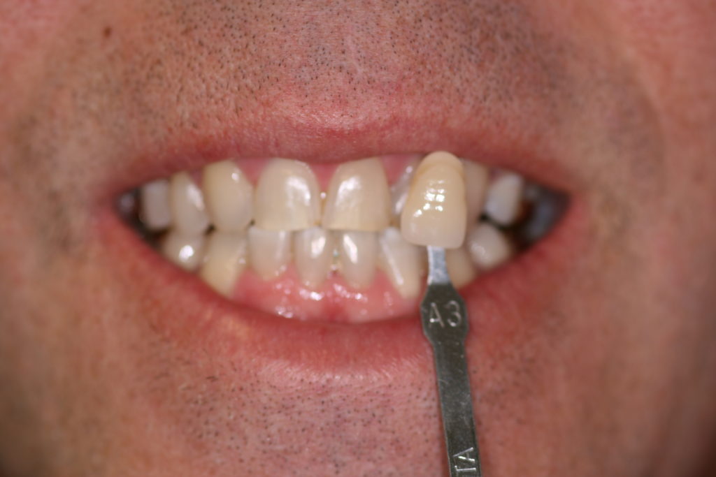 Smile Gallery Whitening Before Jenson Dental Brigham City Utah