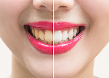 Jenson Dental Teeth Whitening Brigham City