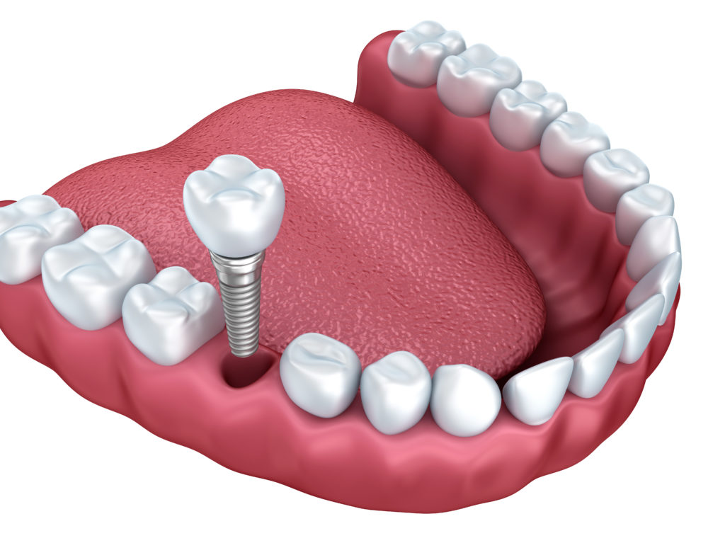 dental implants Brigham City 