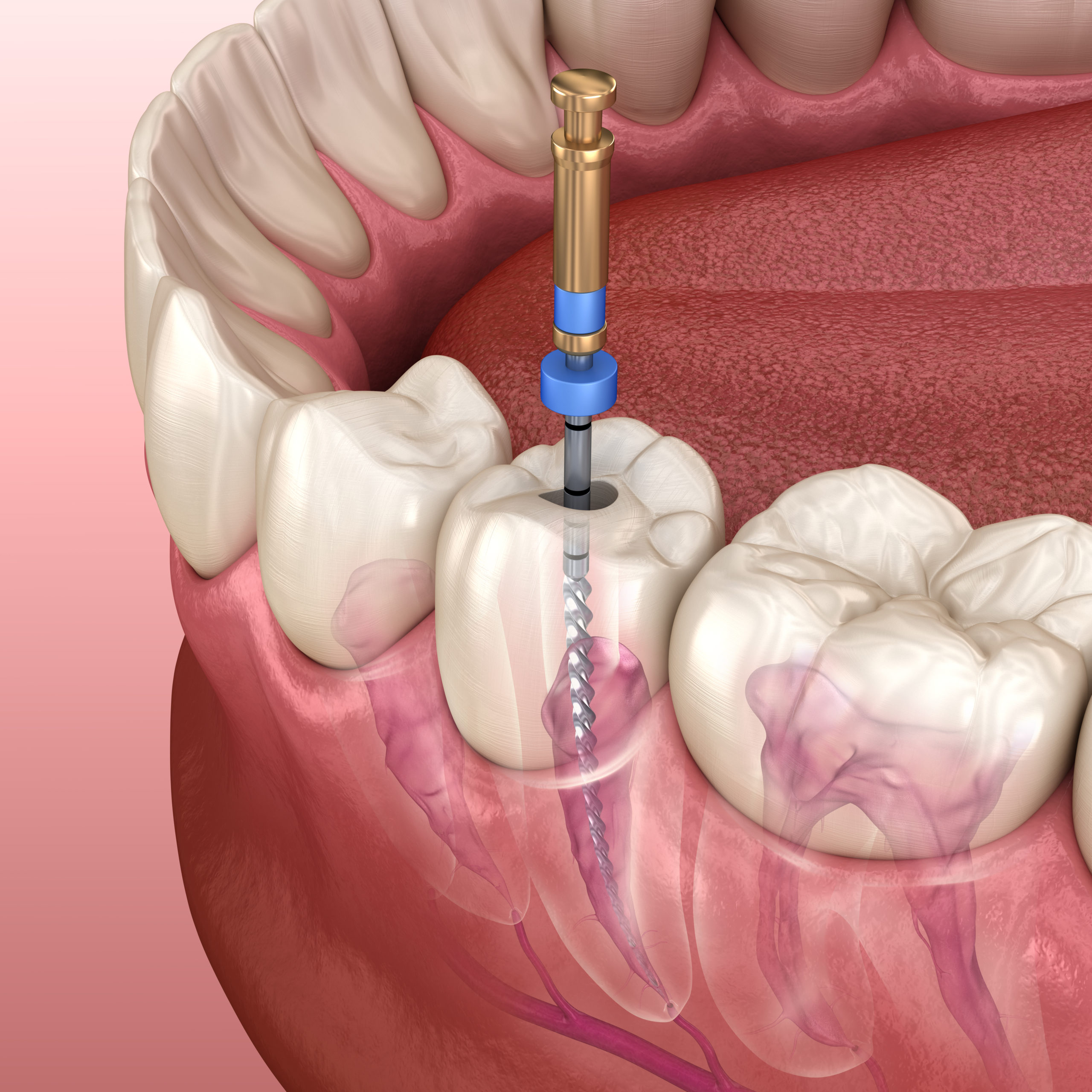 root canal treatment Brigham City Utah