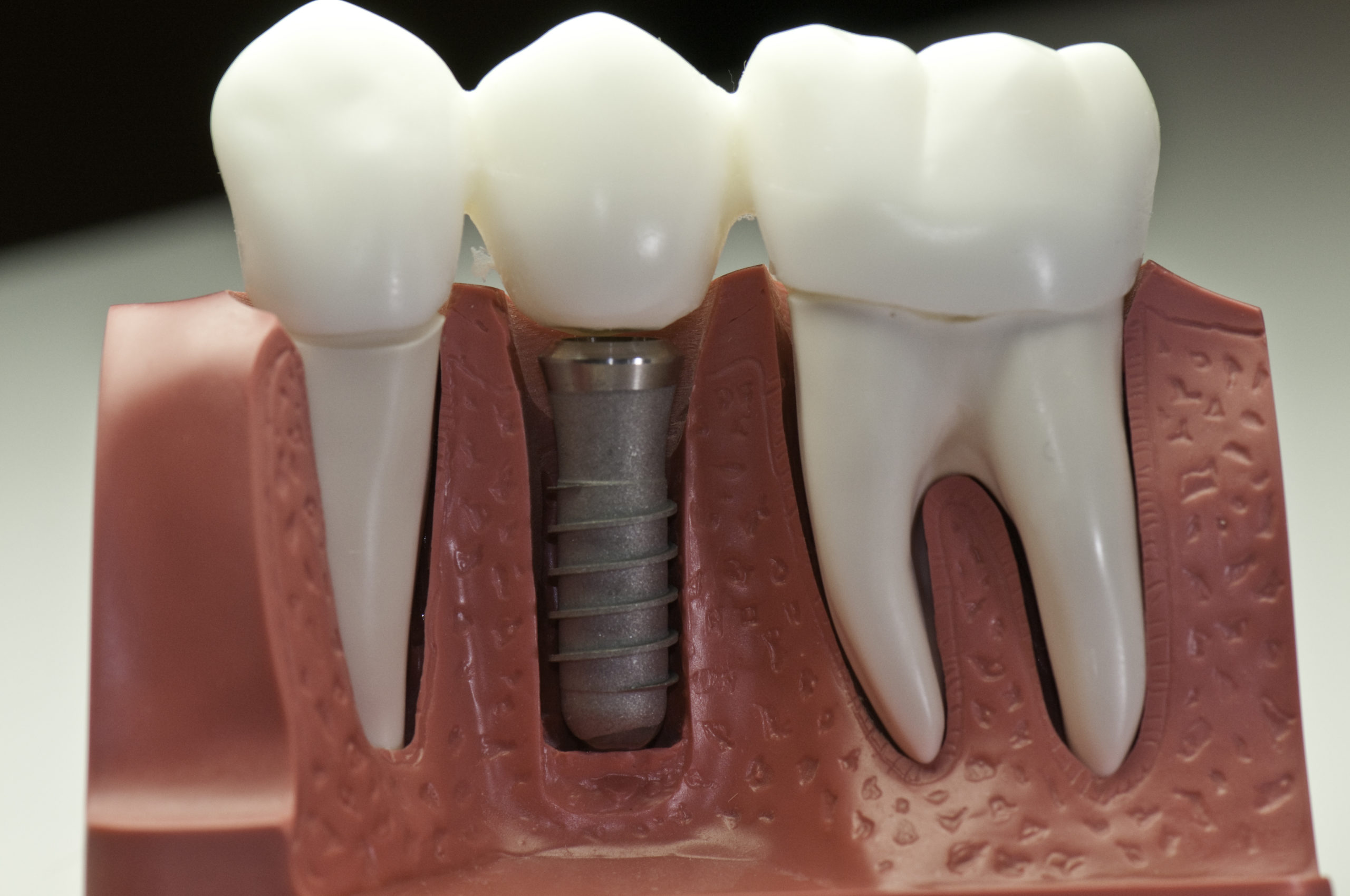 Brigham City UT Dental Implants Sensitive to the cold