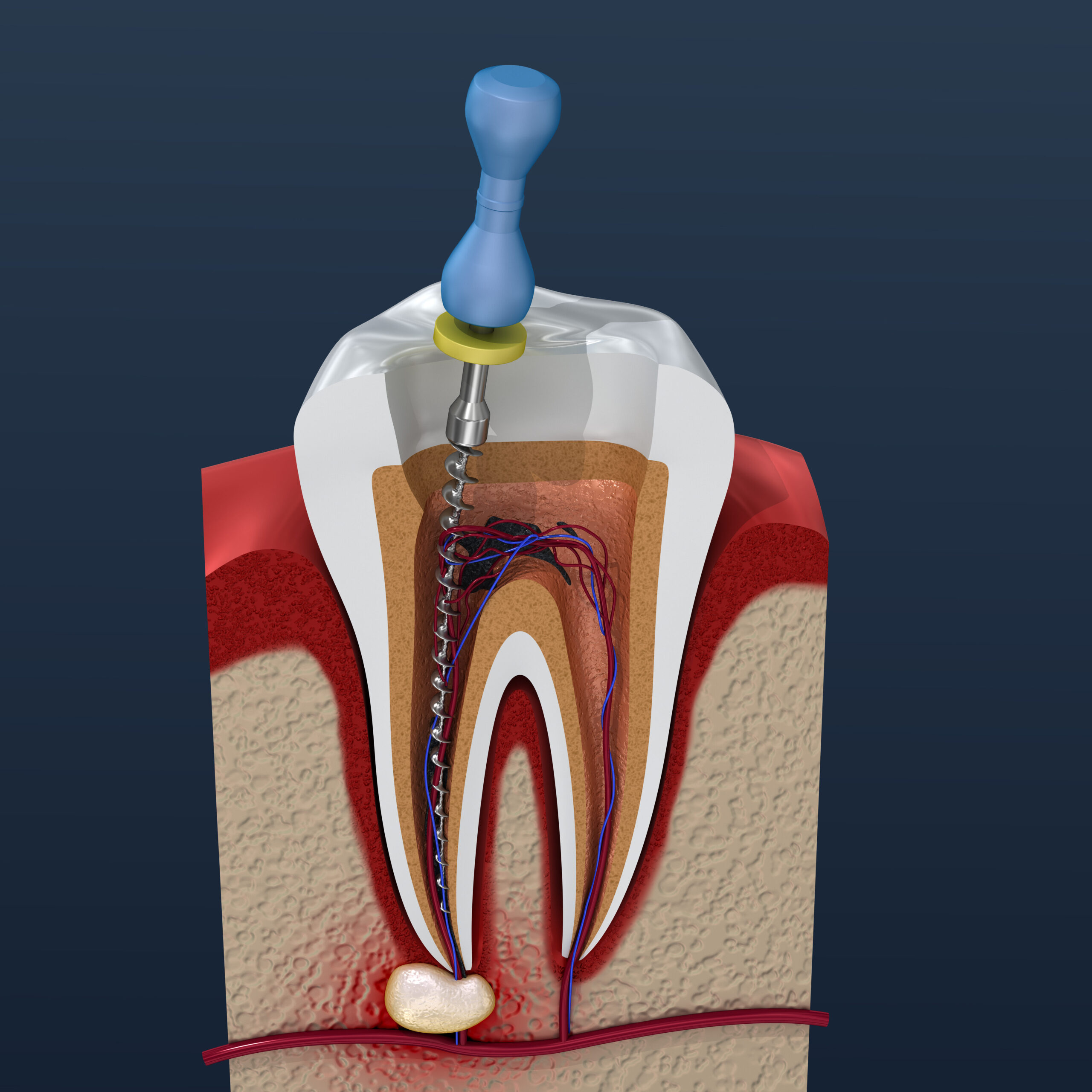 Answers to 4 Questions About Root Canals